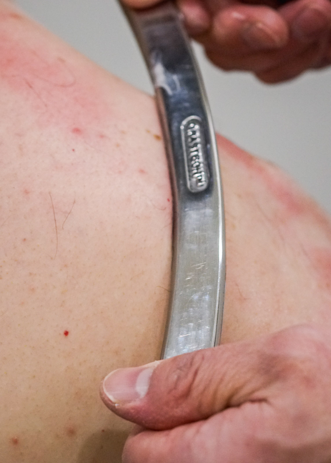 Treating Scar Tissue with the Graston Technique - Wildflower